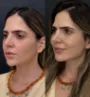 Caso real - harmonização facial em Fortaleza 5.jpg