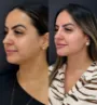 Caso real - harmonização facial em Fortaleza 3.jpg