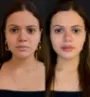 Caso real - harmonização facial em Fortaleza.jpg