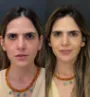 Harmonização facial em Fortaleza - Antes e depois 6.jpg