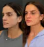 Caso real - harmonização facial em Fortaleza 2.jpg