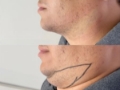 Lipo de papada