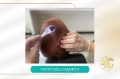 Microagulhamento Capilar