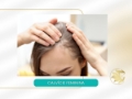 Tratamento para Calvície Feminina