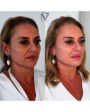 Harmonização Facial- Método Priorizada