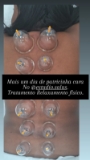 ventosa crio contorno