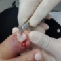 tratamento-unha-encravada-duque-de-caxias