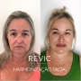 HARMONIZACAO FACIAL EM SJC