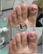 Antes depois