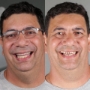 Antes e depois