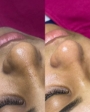limpeza de pele