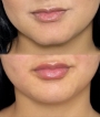 preenchimento labial