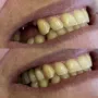 Implante dental