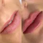 Preenchimento labial