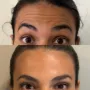 Botox