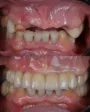Implante dental